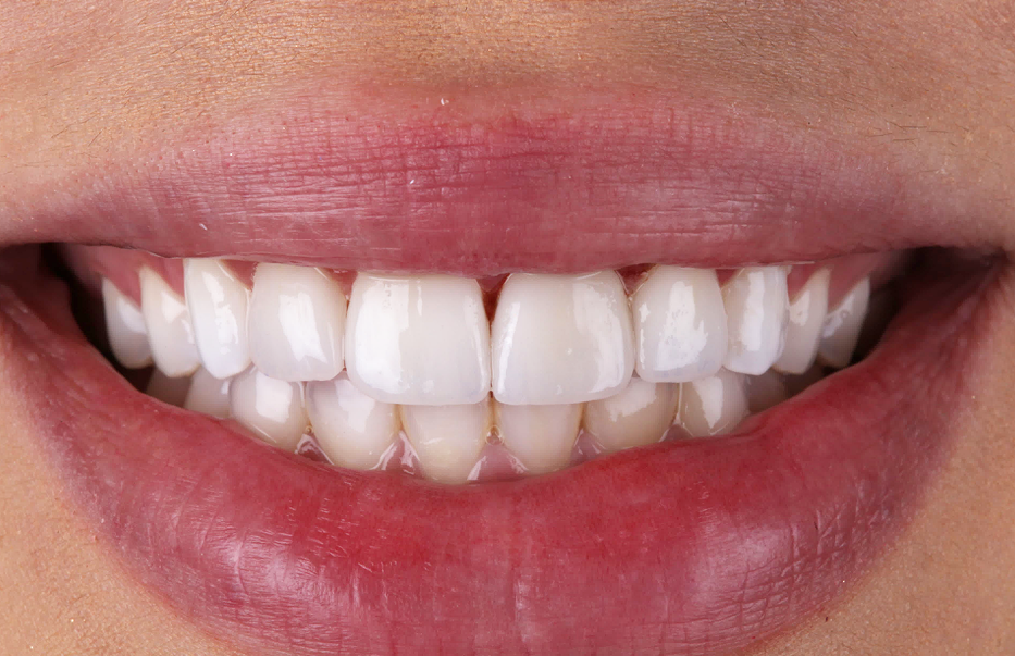Facetas e lentes de contato dental